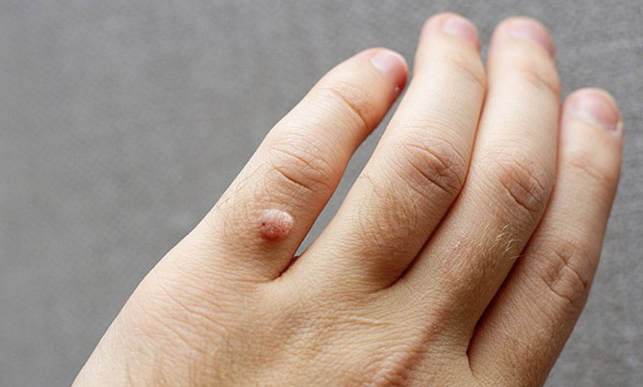 Infeksi Parasit dan Papiloma pada Tubuh